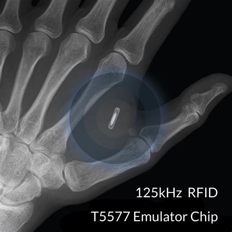 rfid chip insertion|first rfid implant.